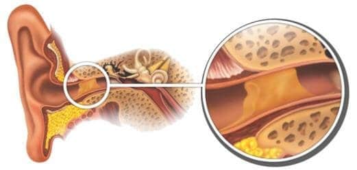 Cerumen (Earwax) Management